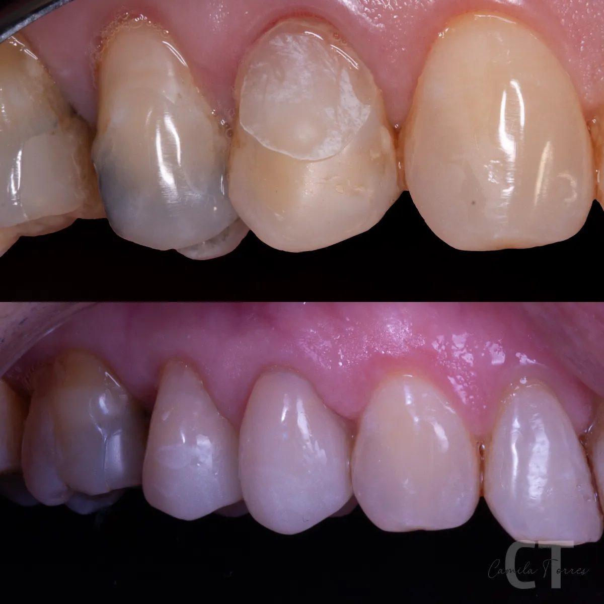 Sonrisa rehabilitada con restauraciones estéticas en dientes anteriores