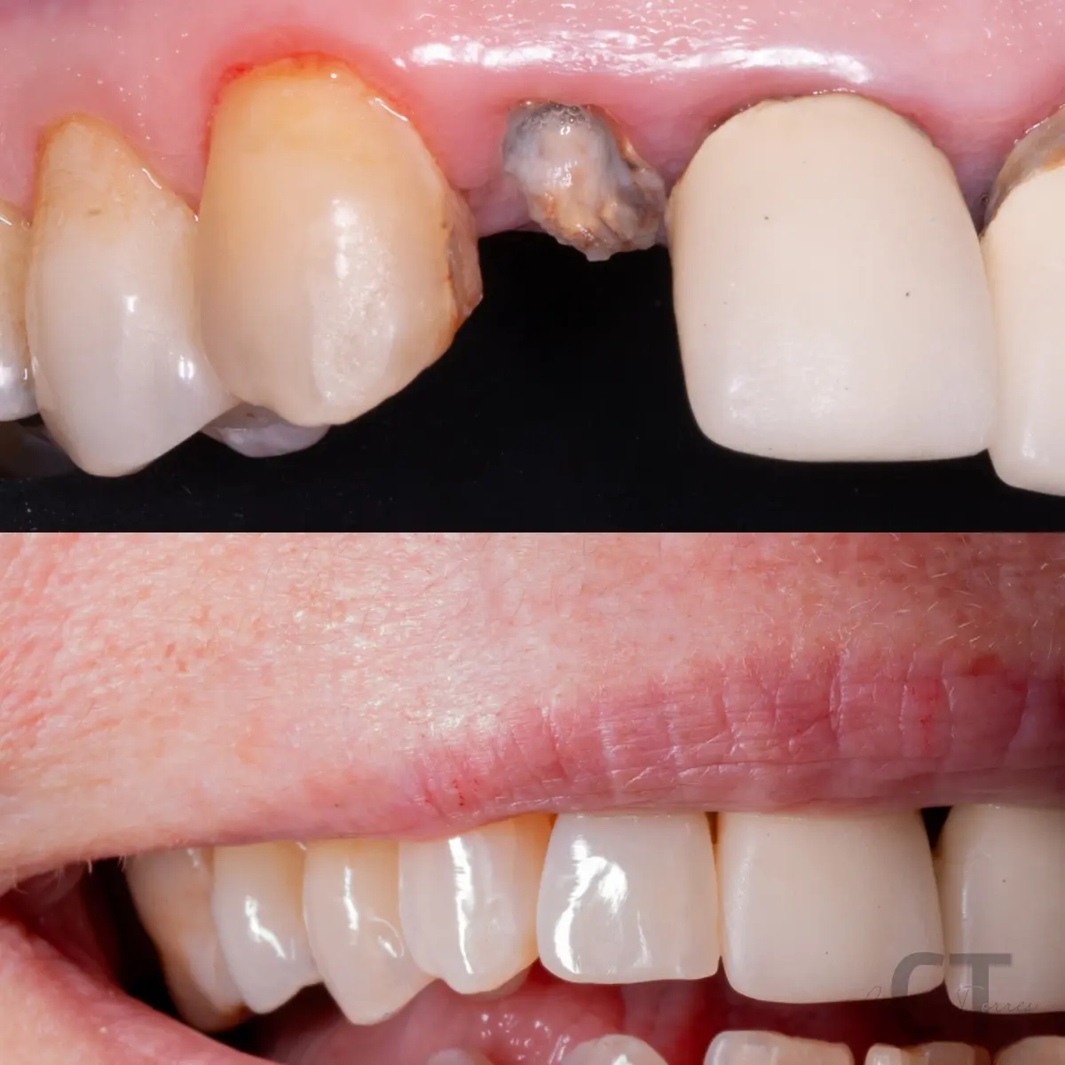 Corrección del color y forma dental con tratamiento restaurador conservador