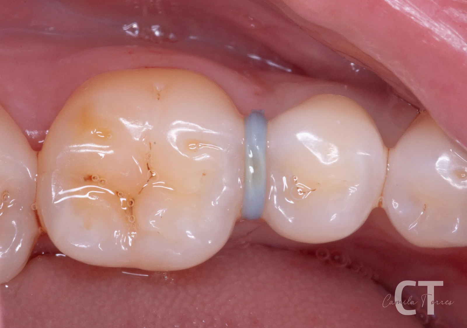 Separación de molares con anillo para acceder a una lesión interproximal incipiente