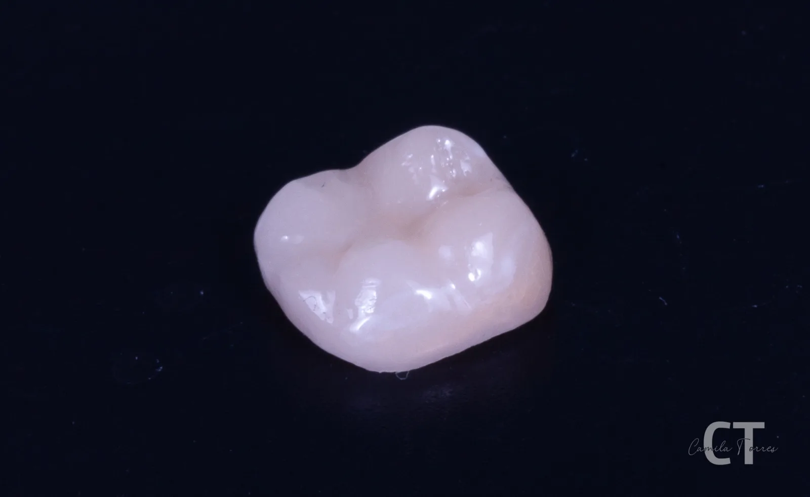 Incrustación cerámica terminada, fabricada a medida para un molar